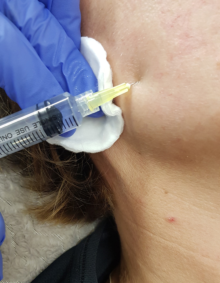 Mesotherapy-–-Introductory